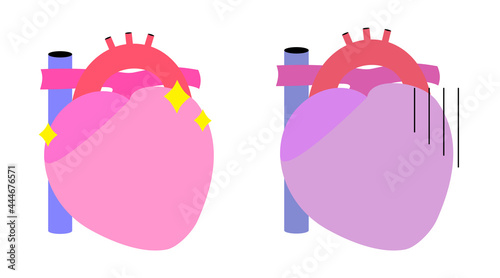 心臓のシンプルなイラスト。健康なものと不健康なものの二つ。