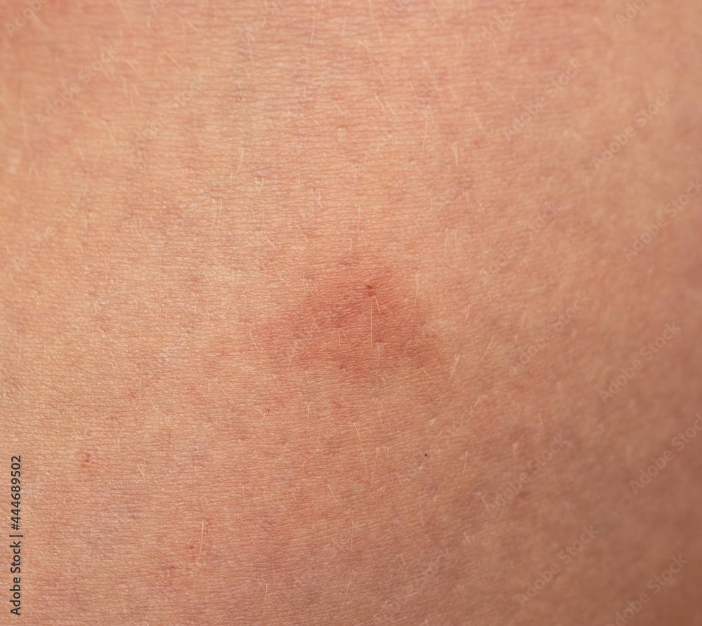 mosquito bites on the leg as background mosquito bites on the leg as background