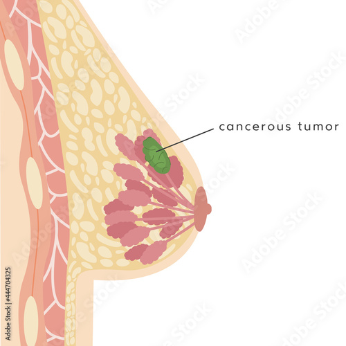 Medical Infographic Cross Section of Female Breast with Cancerous Tumor. Information card of Breast Cancer. Anatomy of Woman Chest. Mammary gland. Vector illustration.