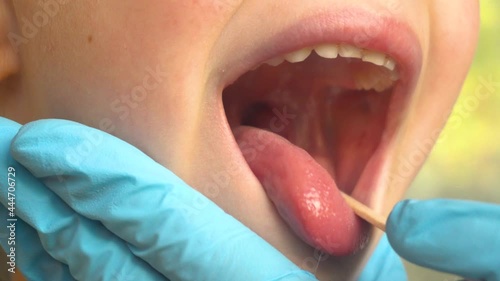 Close-up of a doctor examining a child's mouth and throat using a tongue depressor.ENT medicine.4k