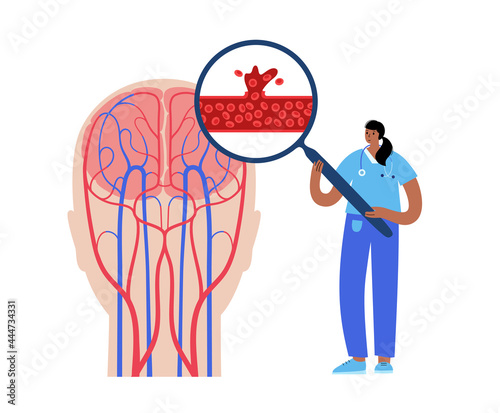 Brain stroke hemorrhagic