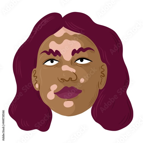 Portrait of a woman with Vitiligo. She has violet hair and wears violet lipstick. 