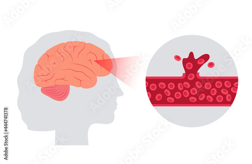 Brain stroke hemorrhagic