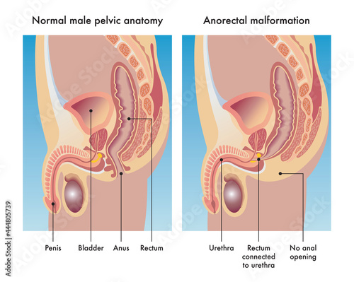 Medical illustration compares a normal male pelvic anatomy with one afflicted with anorectal malformation, with annotations.