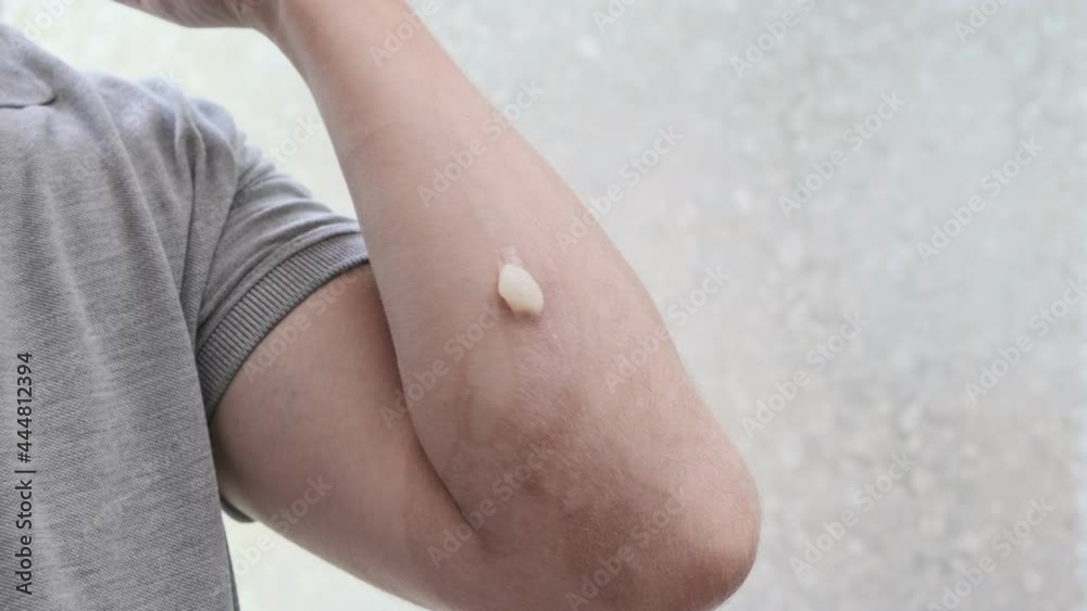 A man applies a cream on his hand to heal scars after a burn. Sunburn