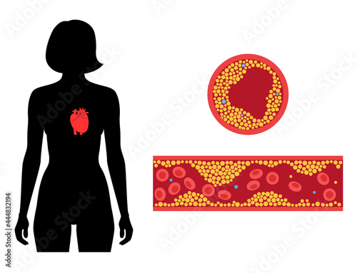 Cholesterol heart disease
