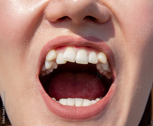 Принти на полотні Curved female teeth, before installing braces