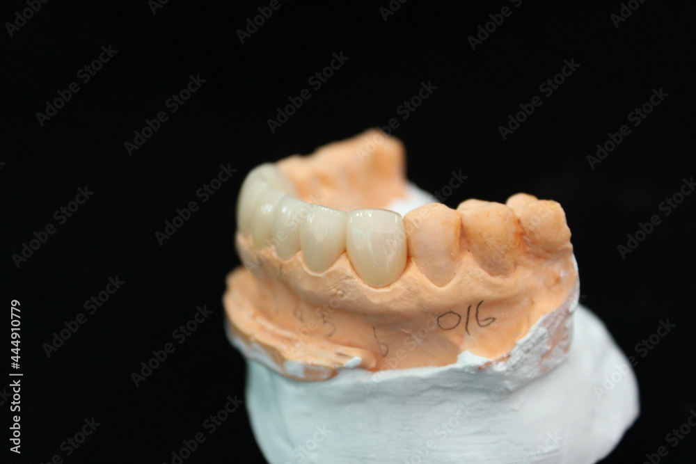 Dental crowns and veneers in the plaster model