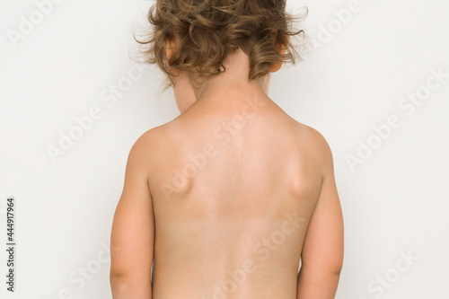 Little girl tanned and not tanned back skin after sunbathing in swimsuit. Isolated on light gray background. Rear view. Closeup.