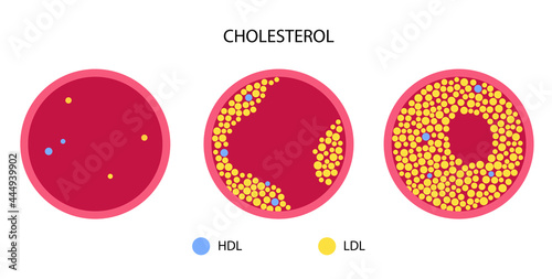 Cholesterol blood artery