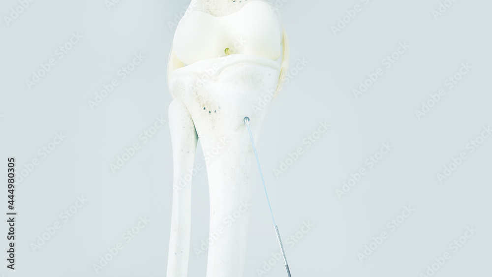 Knee surgery, torn tendon repair, ligament repair, pins, bone drilling