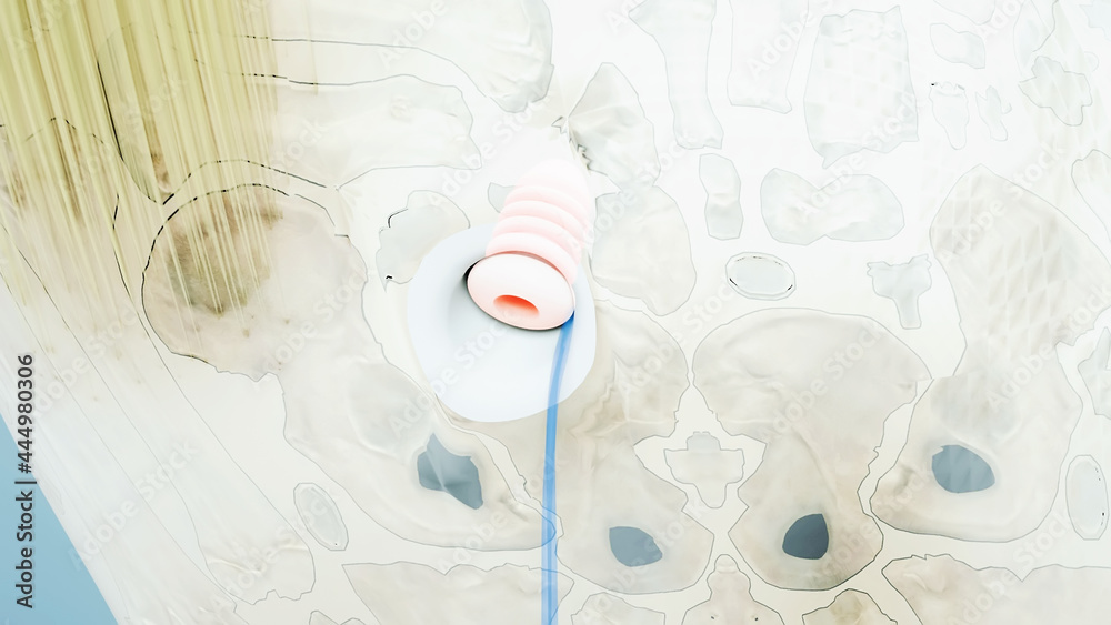 Knee surgery, torn tendon repair, ligament repair, pins, bone drilling