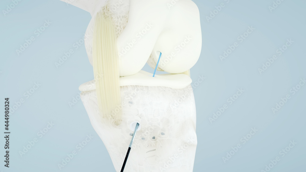 Knee surgery, torn tendon repair, ligament repair, pins, bone drilling