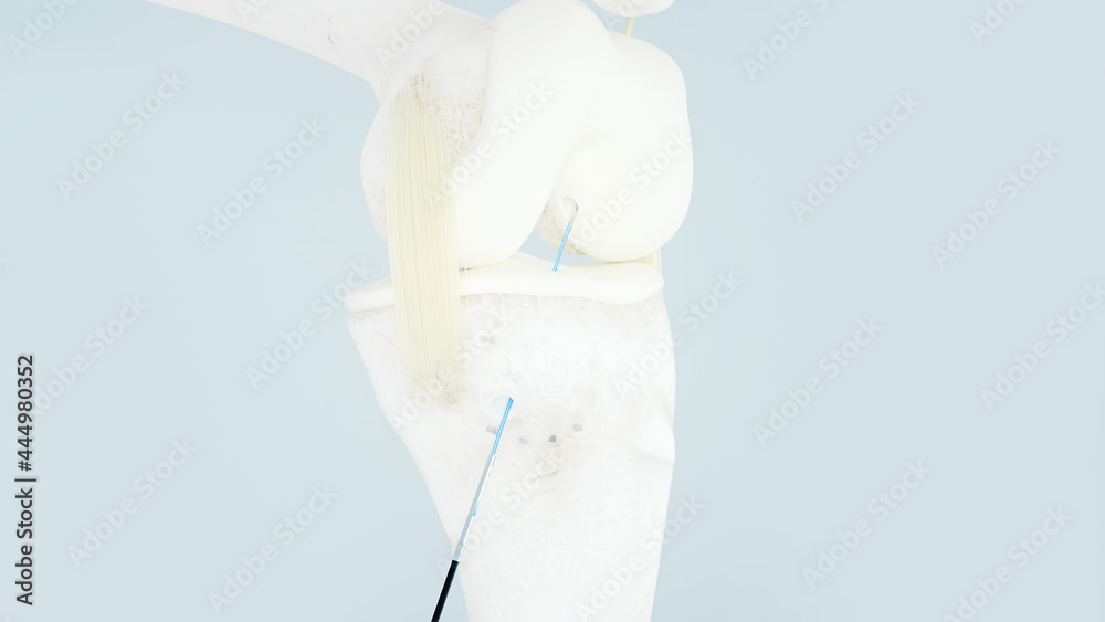 Knee surgery, torn tendon repair, ligament repair, pins, bone drilling