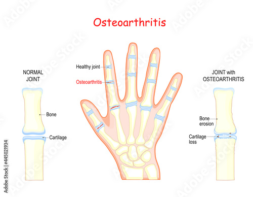 osteoarthritis. Bones of a human hand