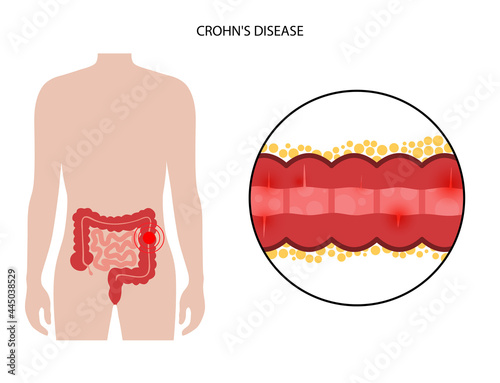 Chrons disease concept