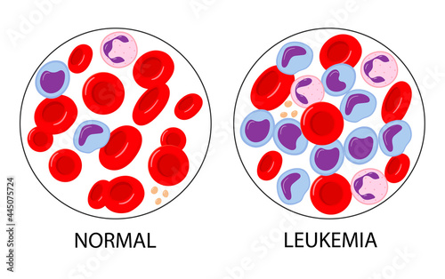 Comparison of normal blood and leukemia. Blood cancer. Red and white blood cells. Isolated vector illustrations in cartoon style.