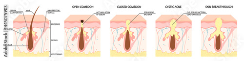 Types of acne. Open comedones, closed comedones, inflammatory acne, cystic acne. Healthy skin care concept photo