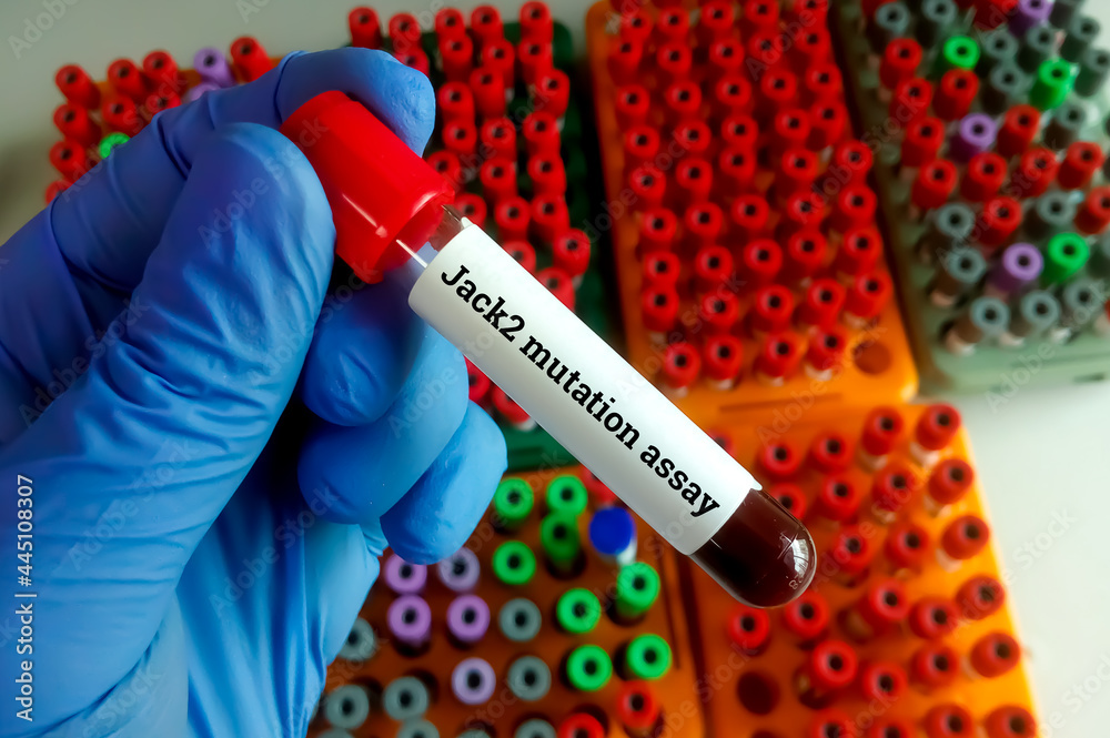 Obraz premium Scientist hold blood sample for Jack2 mutation test, To help diagnose bone marrow disorders known as myeloproliferative neoplasms (MPNs)