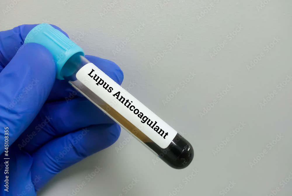 Fototapeta premium Blood Sample for Lupus Anticoagulant (LA). Blood coagulation testing. Medical or health concept