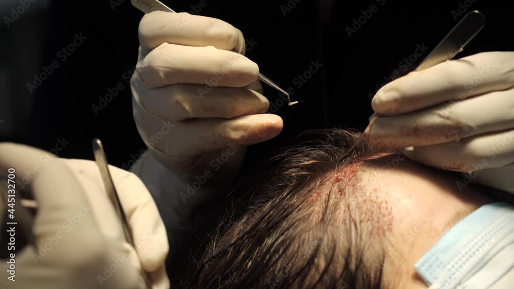 Macrophotography of a hair bulb transplanted into a hairless area. Baldness treatment. Hair transplant. Surgeons in the operating room carry out hair transplant surgery. Surgical technique that moves
