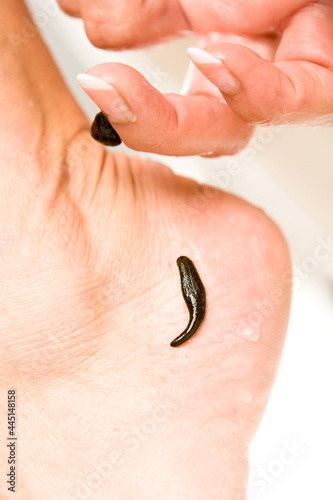 Leech therapy with medical leeches on human body. Naturopathy, healthcare, natural medicine, good blood circulation.