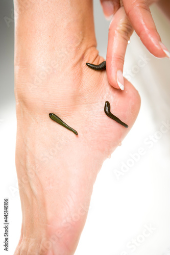 Leech therapy with medical leeches on human body. Naturopathy, healthcare, natural medicine, good blood circulation.