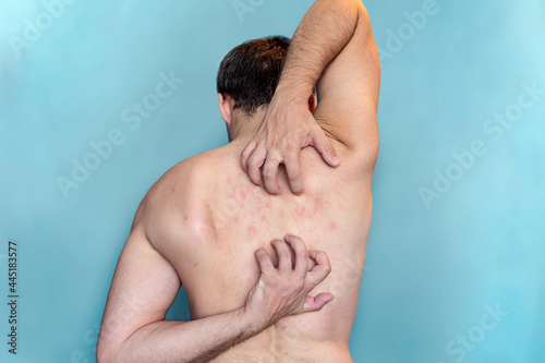 Quadro em tela A man scratches the skin on his back