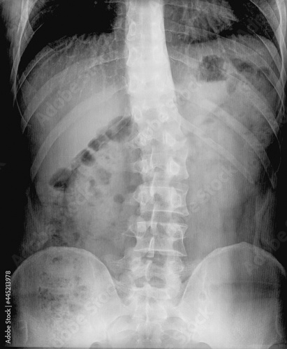 X-ray film of spinal curvature (Scoliosis). Severe medical scoliosis. Diagnosing patient with radiography roentgen scan. Backbone and joint diagnostics. Lumbar and skeleton test.