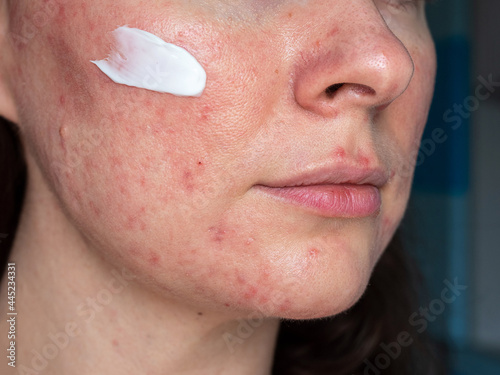 medicated ointment on woman face with rosacea close up photo
