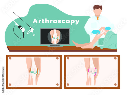 The surgeon's assessing knee arthritis,knee osteoarthritis,meniscus tear. Vector of Arthroscopy medical treatment surgery. Orthopedic surgery illustration. Minimally invasive surgery. photo