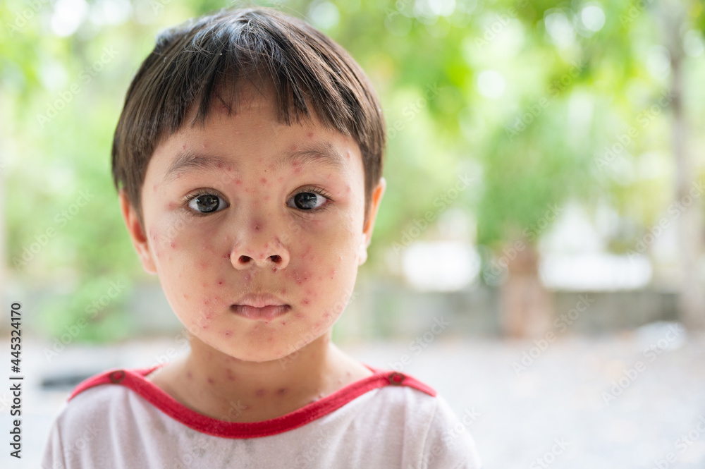 Portrait of sick little boy. Varicella virus or Chickenpox bubble rash on child Portrait of sick little boy. Varicella virus or Chickenpox bubble rash on child