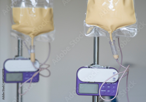 Fotografija Couple of feeding pump medical device purple color to supplement nutrition liquid food to tube enteral feeding fluid set bag with clamp hanging on stand