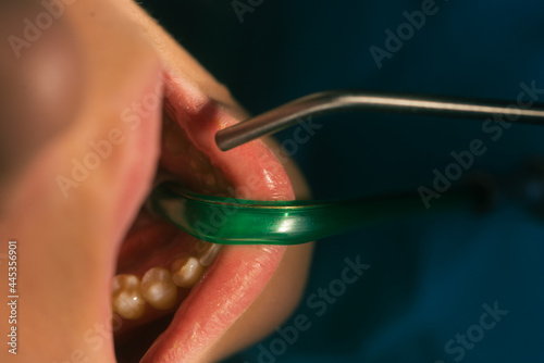 Closeup clean dental examination on a woman s teeth in a dental office