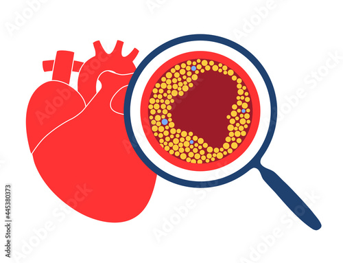 Cholesterol heart disease