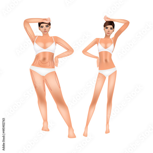 Realistic female body, the girl is plump and thin. Medical vector illustration