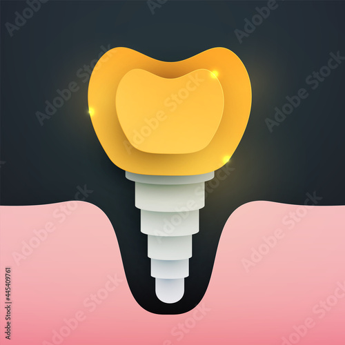 Human golden tooth implant silhouette in modern creative style. Luxury minimalistic design concept. Premium healthcare medical composition art element. Bright paper cut layer vector illustration.