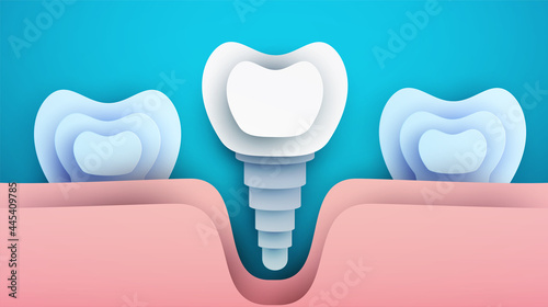 Human tooth implant silhouette in modern creative style. Minimalistic design concept. Healthcare medical composition art element. Paper cut layer vector illustration.