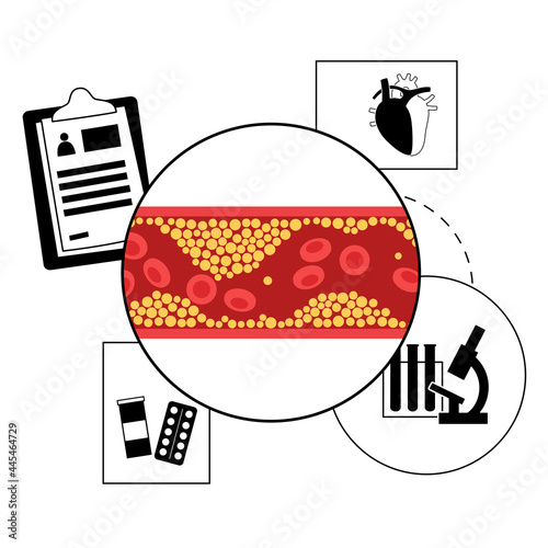 Cholesterol heart disease