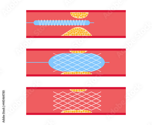 Angioplasty cardiac stent