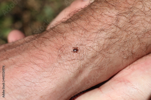 Dangerous for health a blood-sucking tick on a human hand on a bright sunny day. photo