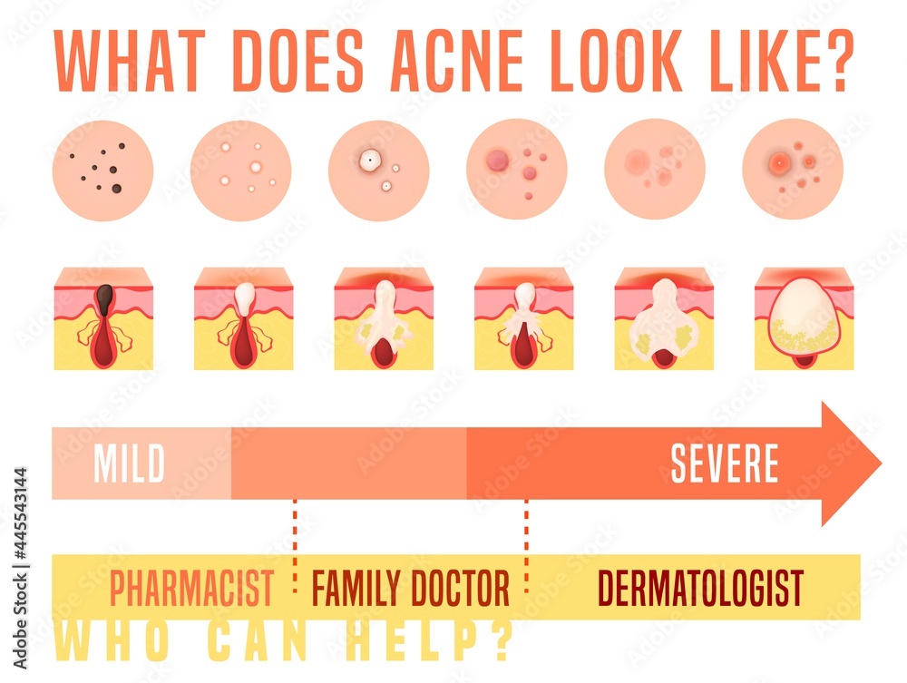 Obraz premium Acne types set. Skin disease, dermatology, cosmetology concept.
