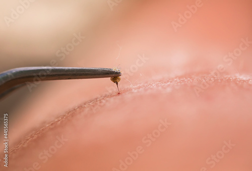 bee sting with poison pulls out a metal tweezers from the skin after a sick bite