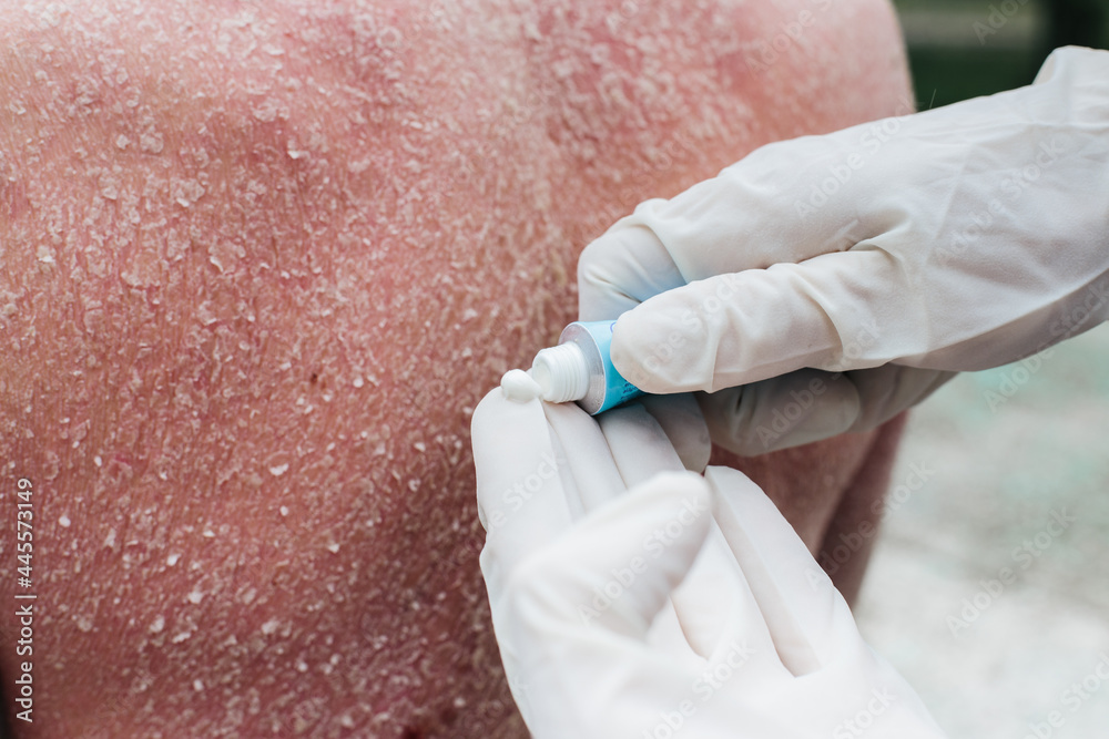 A dermatologist wearing gloves examines the skin of a sick patient
