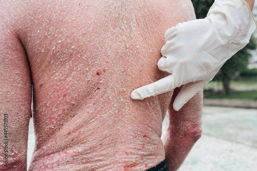 Doctor examining patient with psoriasis on back, closeup. Outdoor photo