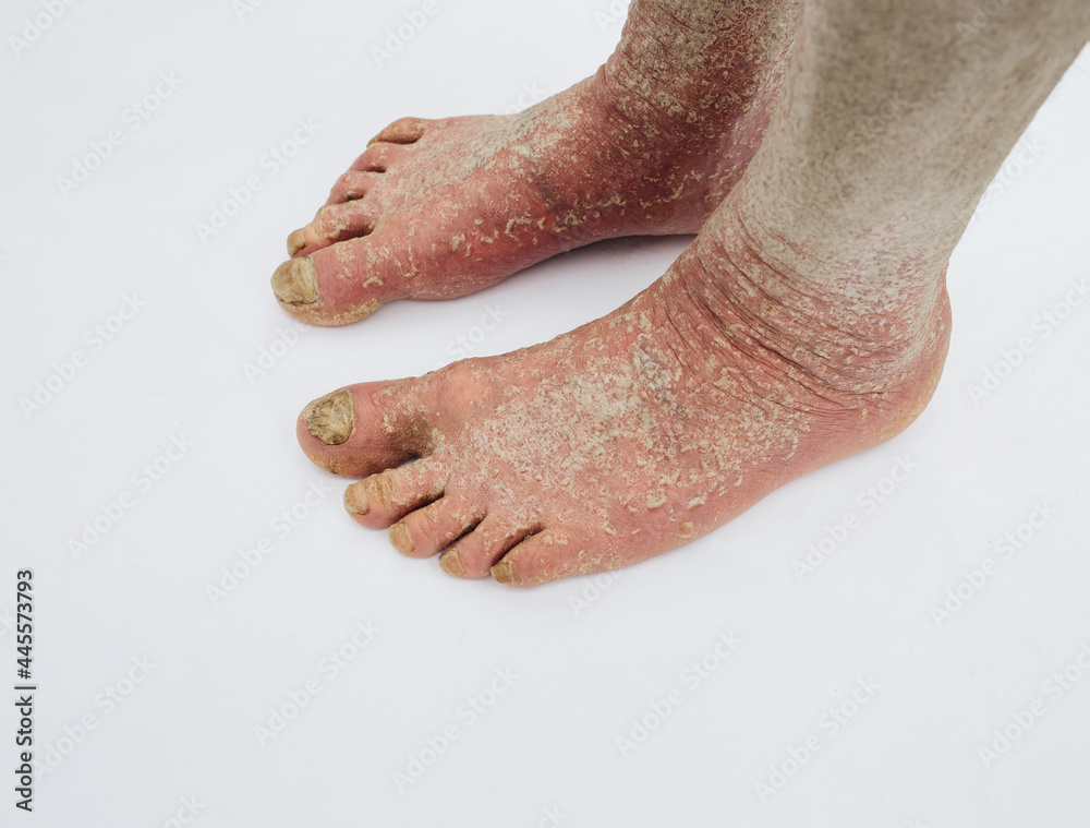 The doctor diagnoses the injured foot. Dry skin, Psoriasis of the feet. The skin is damaged. Dermatitis, eczema, psoriasis, allergic reaction. Peeling and cracking on the foot of a person. The doctor diagnoses the injured foot. Dry skin, Psoriasis of the feet. The skin is damaged. Dermatitis, eczema, psoriasis, allergic reaction. Peeling and cracking on the foot of a person.