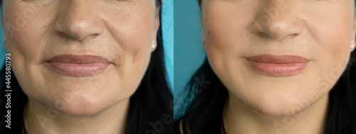 Slika na platnu woman face wrinkles before and after treatment