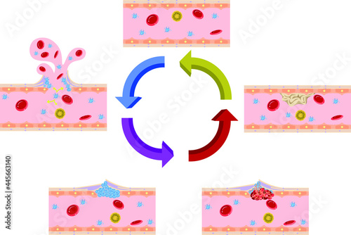 血管修復イラスト