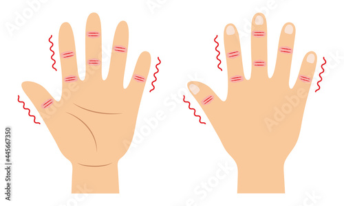 指先が裂けて痛い「ひび」と「あかぎれ」