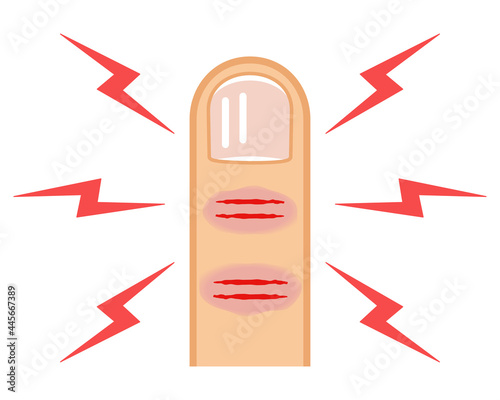 指先の「ひび」と「あかぎれ」